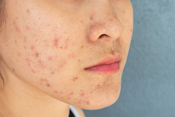 Acne Prone Skin