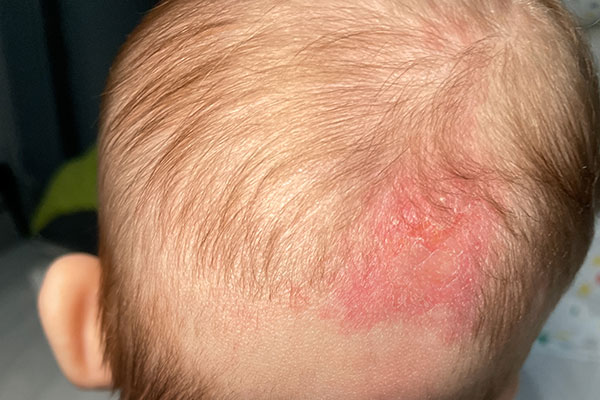 Cradle Cap
