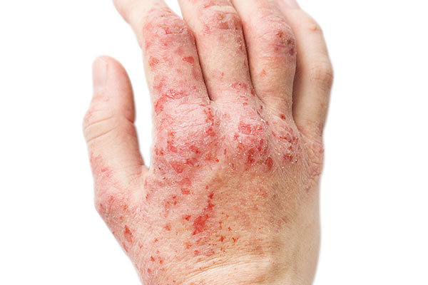 Eczema Dermatitis