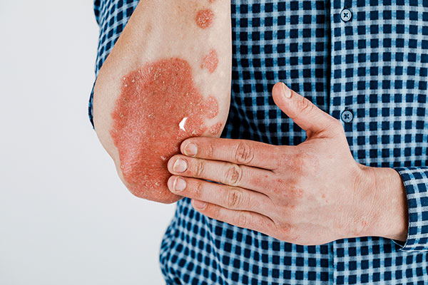 Psoriasis